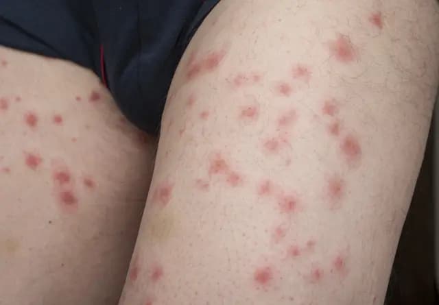 Struggling to Get Rid of Bed Bugs Common Challenges Explained